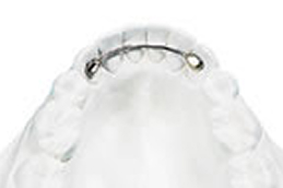 リンガルボンデットリテーナー