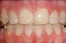 可撤式矯正装置（QCMリテーナー）