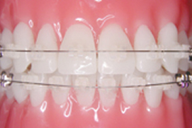 白ブラケット＋金属ワイヤー