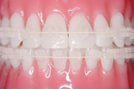 白ブラケット＋白ワイヤー