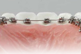 リンガルブラケット矯正装置（クリッピーL）