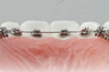 カスタムメイド型リンガルブラケット矯正装置