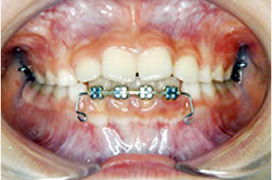 部分的ブラケット装置
